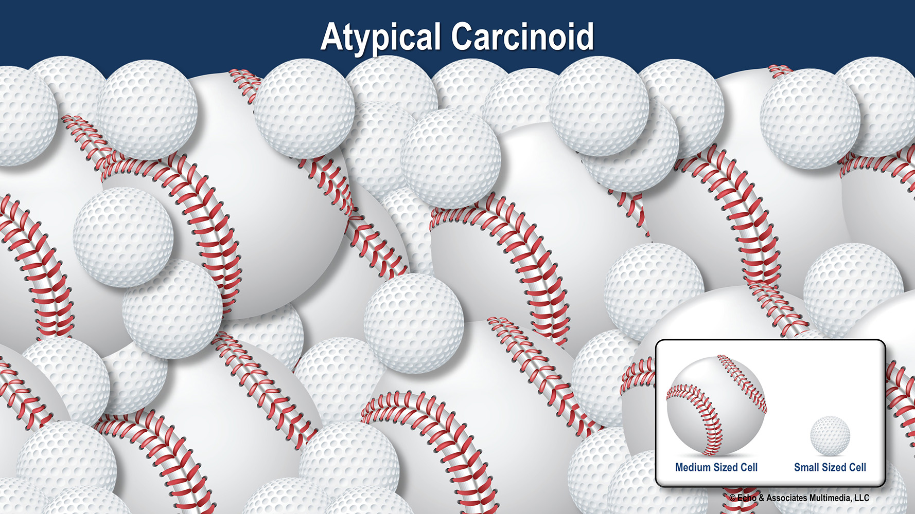Atypical Carcinoid